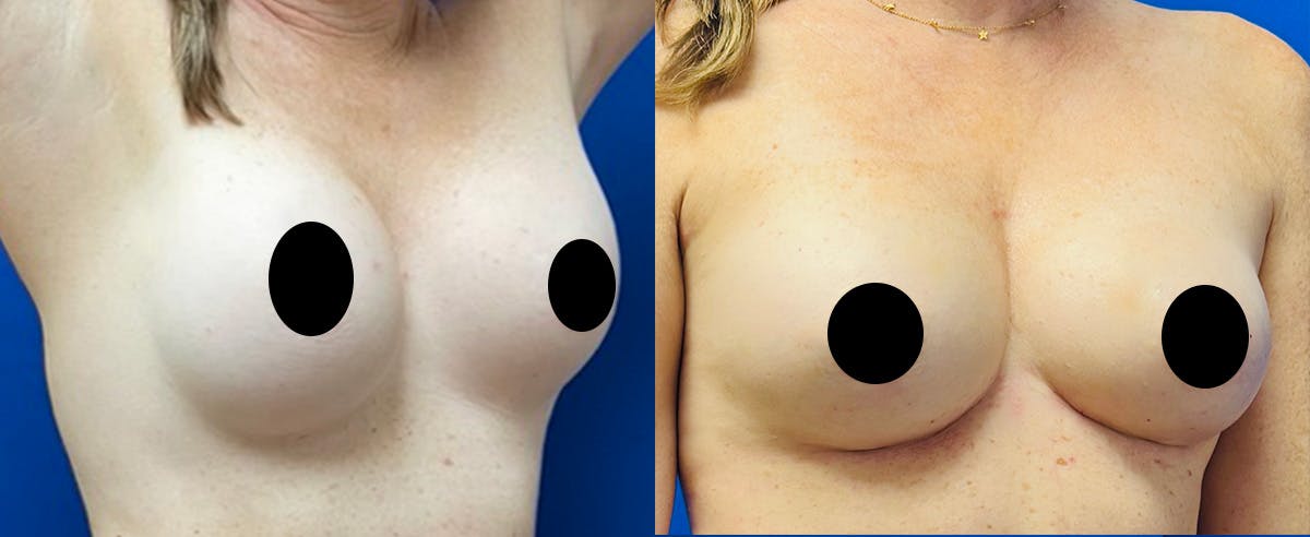 Fat Grafting Before & After Gallery - Patient 285906 - Image 2