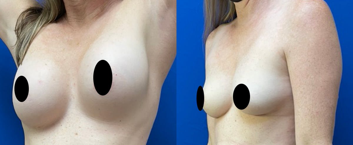 Fat Grafting Before & After Gallery - Patient 285906 - Image 3