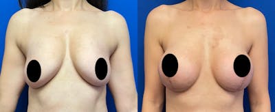 Breast Augmentation Before & After Gallery - Patient 382292 - Image 1