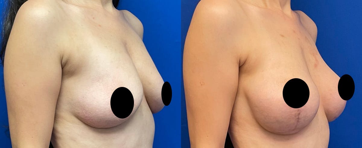 Breast Augmentation Before & After Gallery - Patient 382292 - Image 2