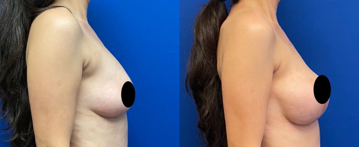 Breast Augmentation Before & After Gallery - Patient 382292 - Image 3