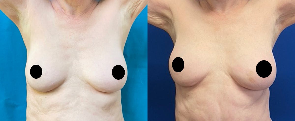 Breast Augmentation Before & After Gallery - Patient 366447 - Image 1