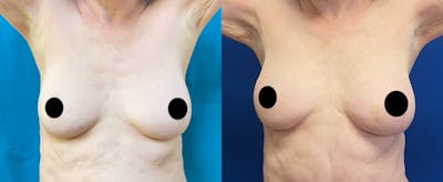 Breast Augmentation Before & After Gallery - Patient 366447 - Image 1