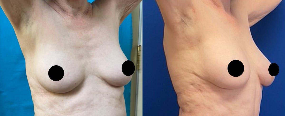 Breast Augmentation Before & After Gallery - Patient 366447 - Image 2