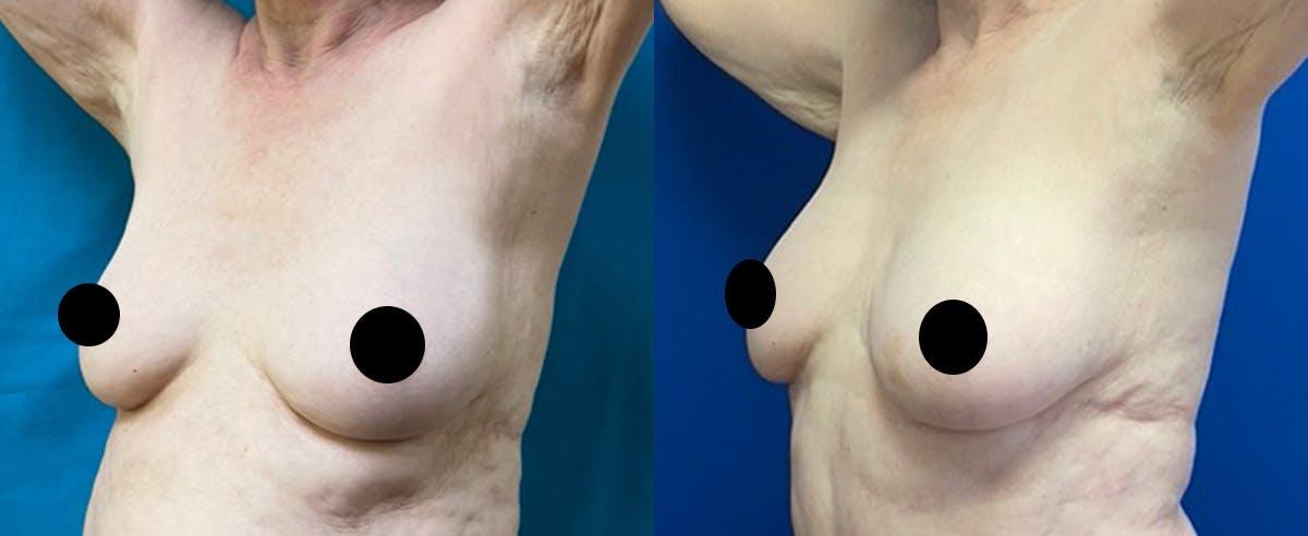 Breast Augmentation Before & After Gallery - Patient 366447 - Image 3