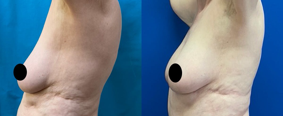 Breast Augmentation Before & After Gallery - Patient 366447 - Image 4