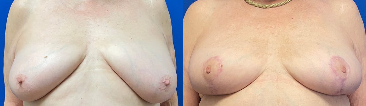Breast Reduction Before & After Gallery - Patient 406113 - Image 1
