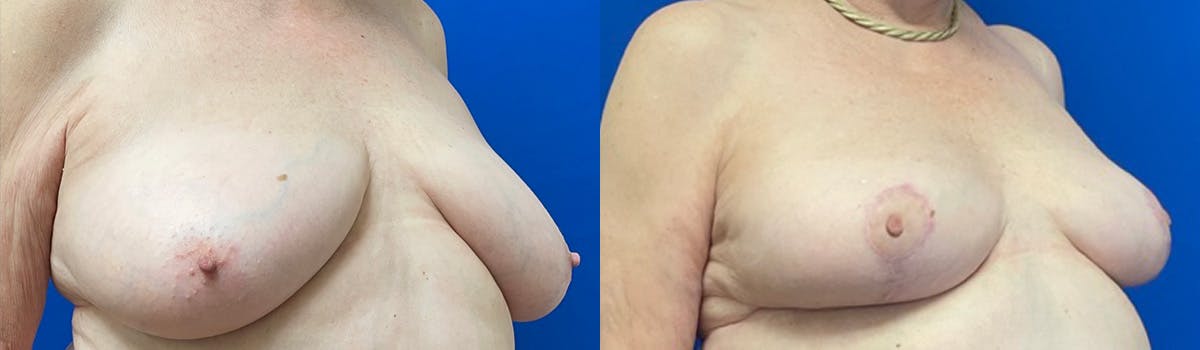 Breast Reduction Before & After Gallery - Patient 406113 - Image 2