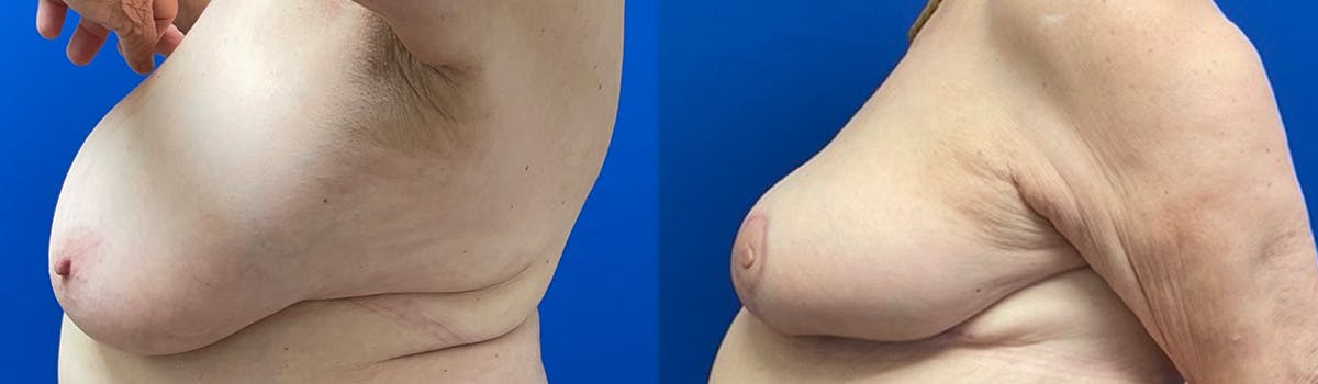 Breast Reduction Before & After Gallery - Patient 406113 - Image 3