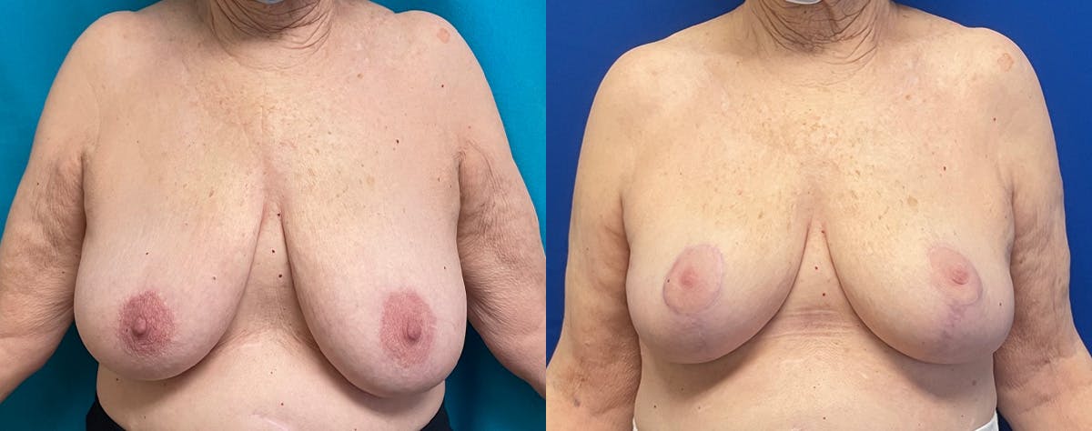 Breast Reduction Before & After Gallery - Patient 314461 - Image 1