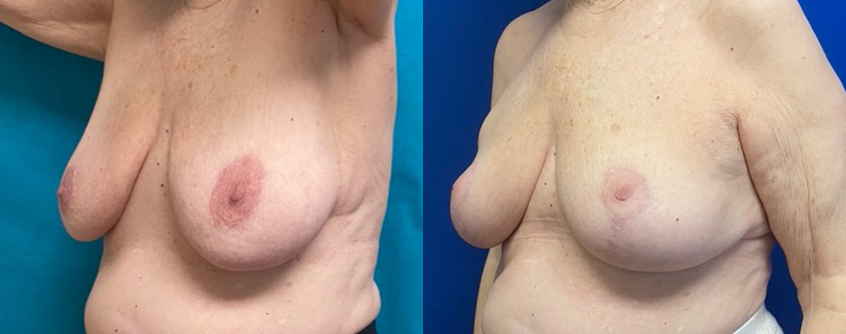 Breast Reduction Before & After Gallery - Patient 314461 - Image 2