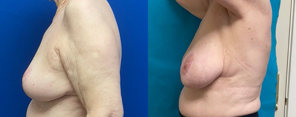 Breast Reduction Before & After Gallery - Patient 314461 - Image 3