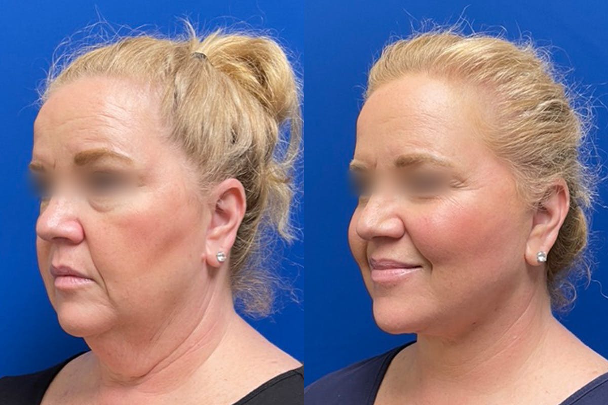 Neck Lift Before & After Gallery - Patient 303857 - Image 3