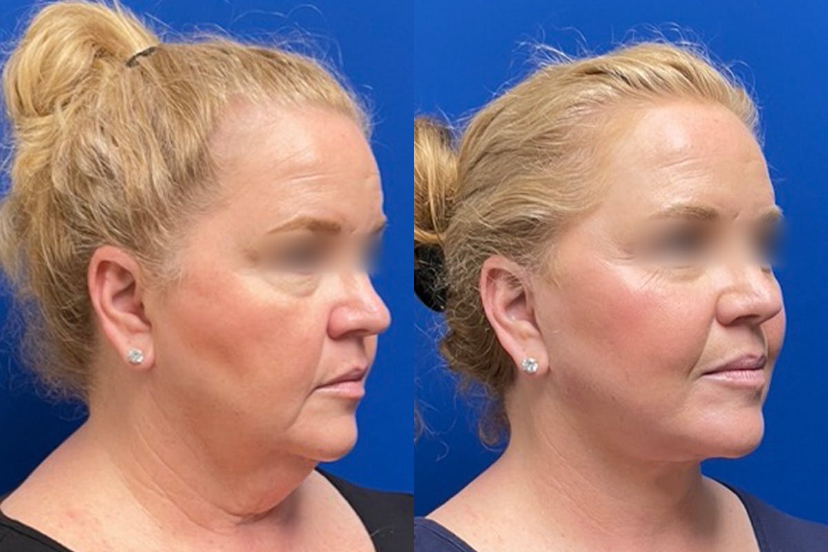 Neck Lift Before & After Gallery - Patient 303857 - Image 2