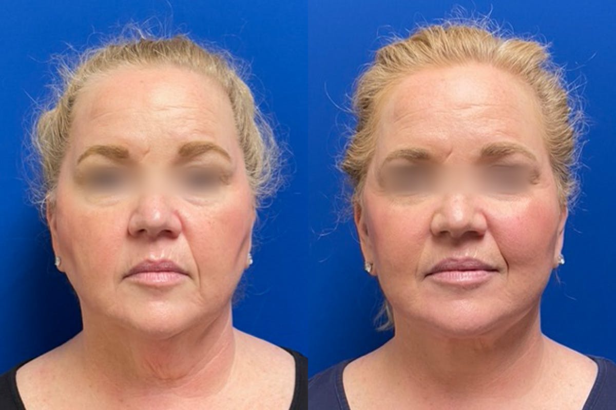 Neck Lift Before & After Gallery - Patient 303857 - Image 1