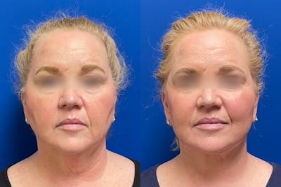 Facelift Before & After Gallery - Patient 231967 - Image 1