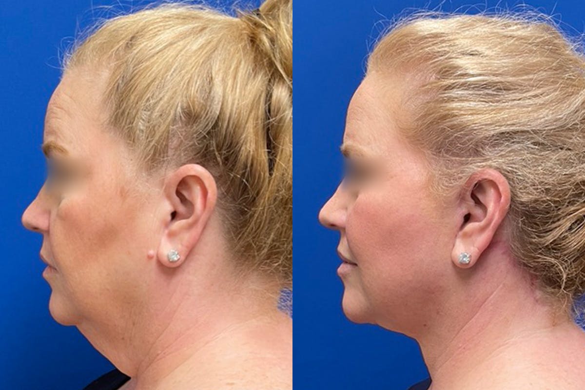 Neck Lift Before & After Gallery - Patient 303857 - Image 4