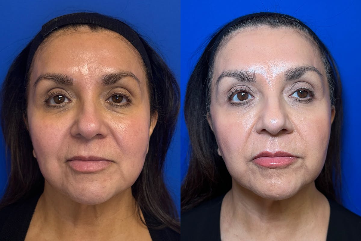 Laser Skin Resurfacing Before & After Gallery - Patient 226675 - Image 1