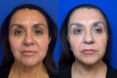 Laser Skin Resurfacing Before & After Gallery - Patient 226675 - Image 1