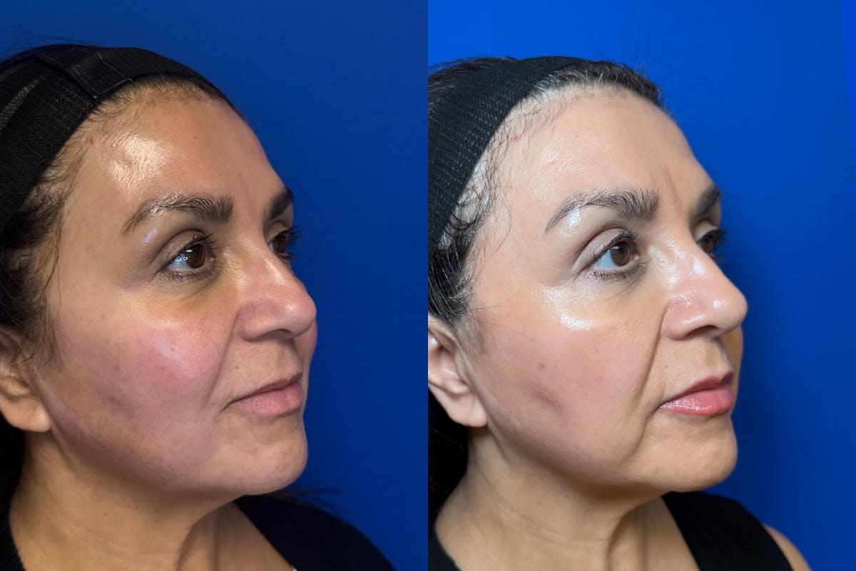 Laser Skin Resurfacing Before & After Gallery - Patient 226675 - Image 2