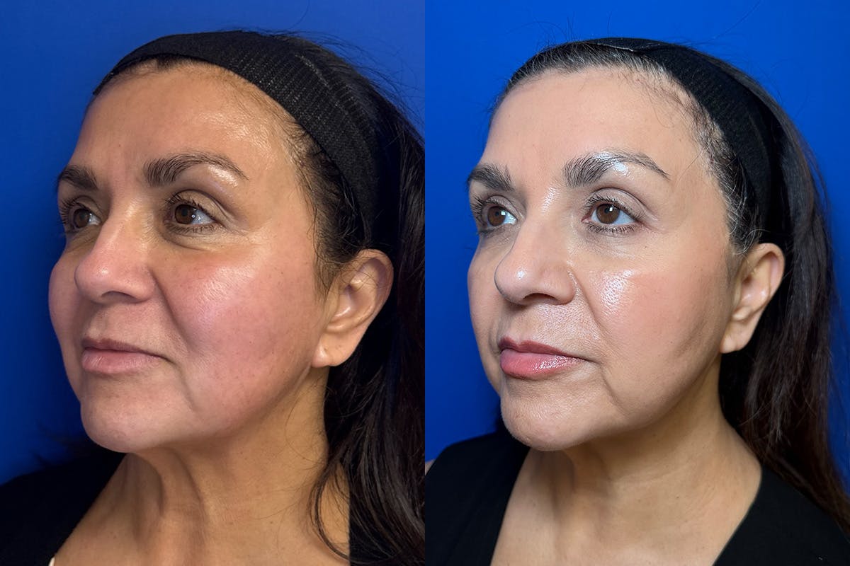 Laser Skin Resurfacing Before & After Gallery - Patient 226675 - Image 3