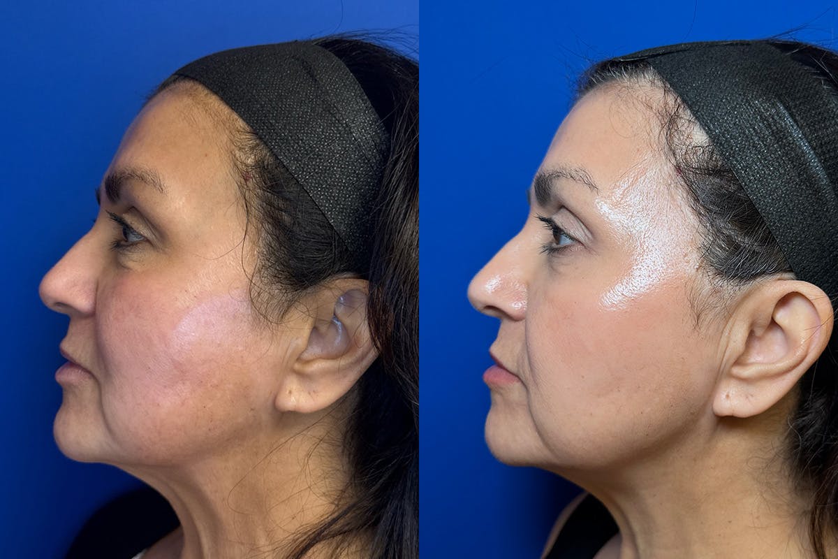 Laser Skin Resurfacing Before & After Gallery - Patient 226675 - Image 4