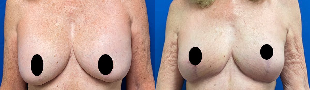 Fat Grafting Before & After Gallery - Patient 119518 - Image 1