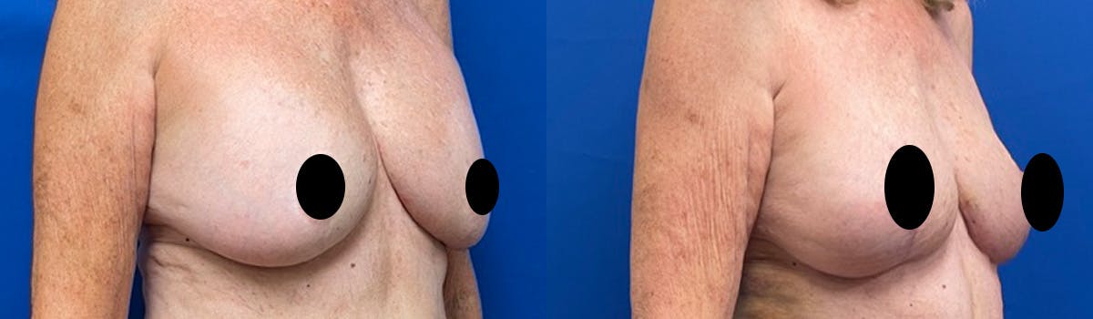 Fat Grafting Before & After Gallery - Patient 119518 - Image 2