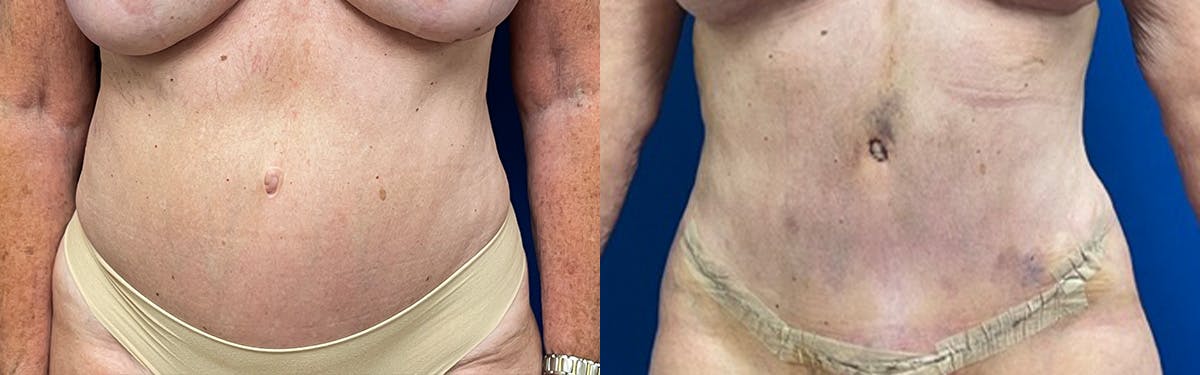 Liposuction Before & After Gallery - Patient 131455 - Image 1
