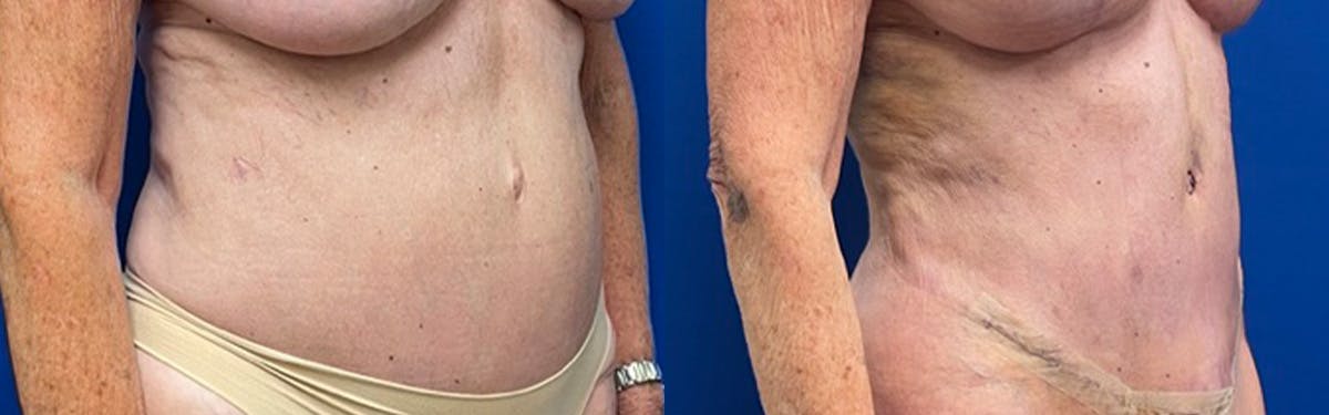 Liposuction Before & After Gallery - Patient 131455 - Image 2