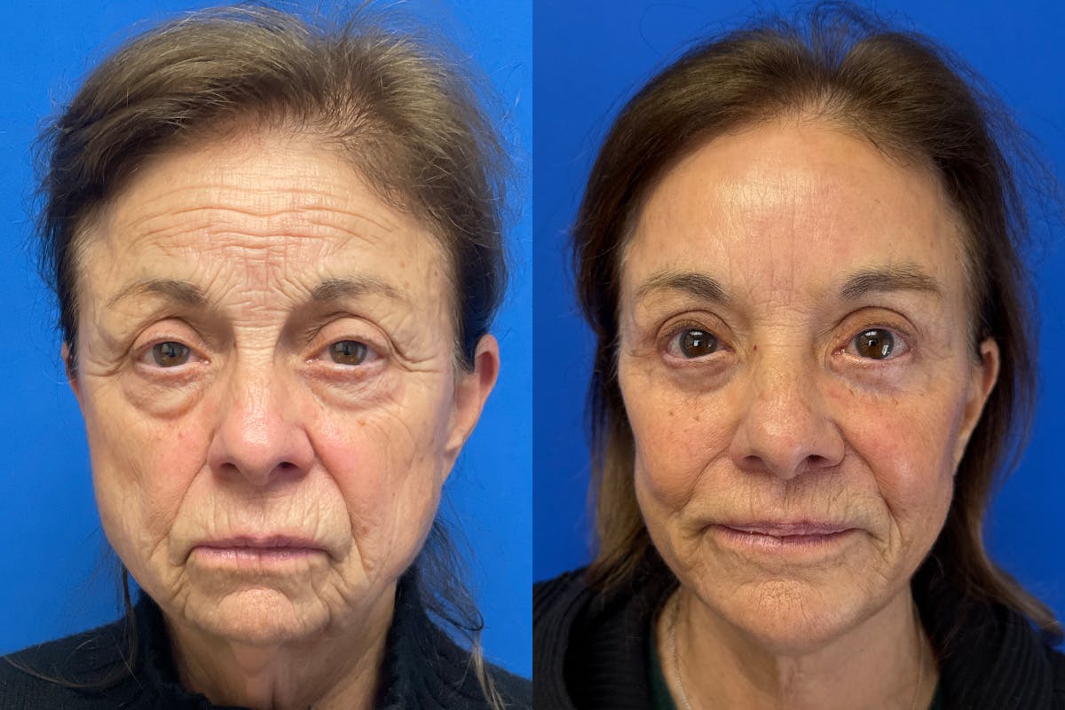 Facelift Before & After Gallery - Patient 500054 - Image 1