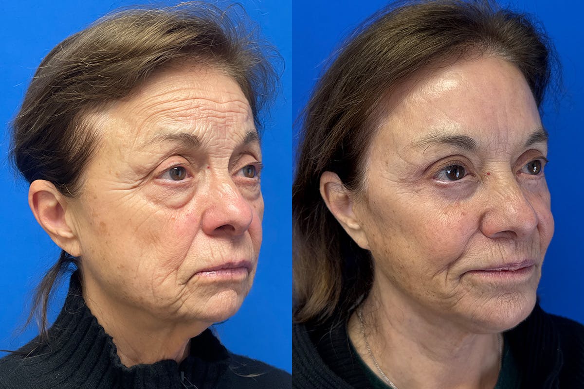 Facelift Before & After Gallery - Patient 500054 - Image 2