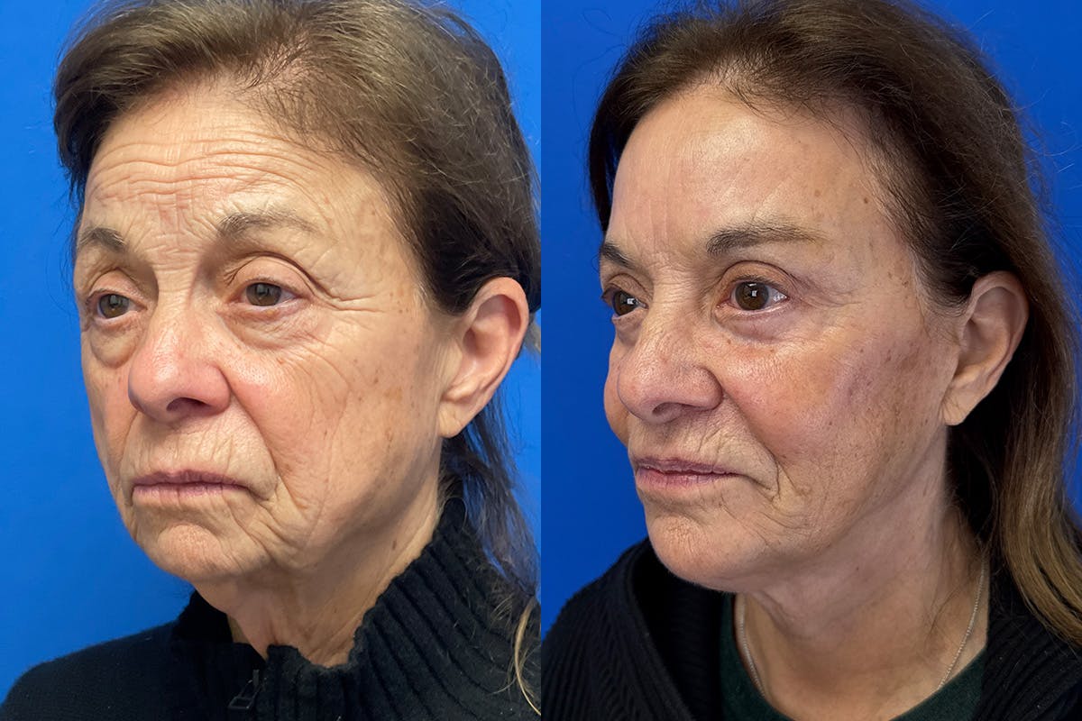 Facelift Before & After Gallery - Patient 500054 - Image 4