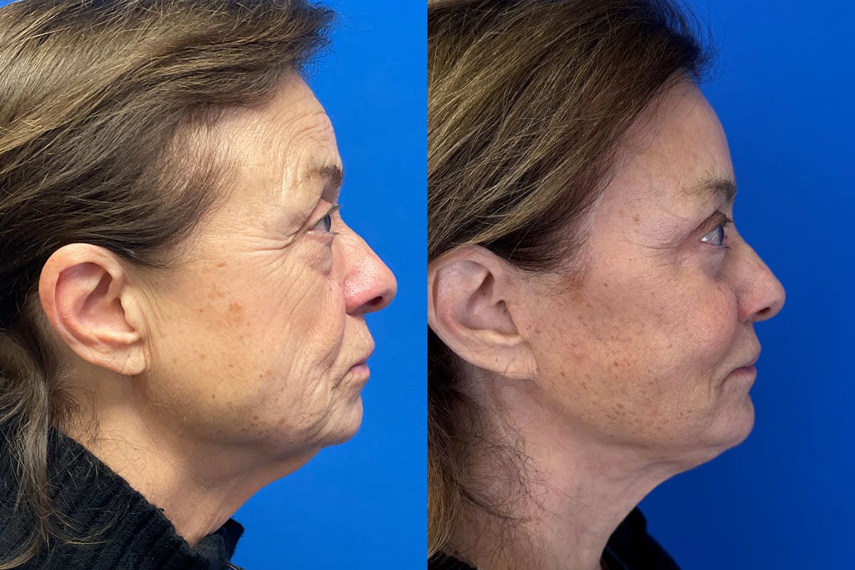Facelift Before & After Gallery - Patient 500054 - Image 3