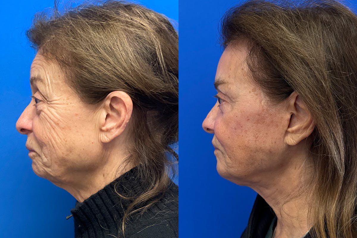 Facelift Before & After Gallery - Patient 500054 - Image 5