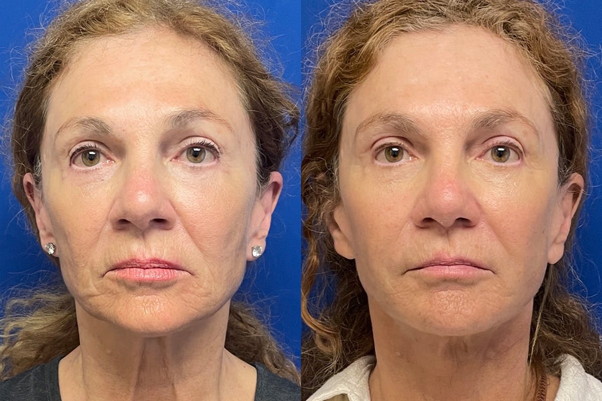 Facelift Before & After Gallery - Patient 256427 - Image 1