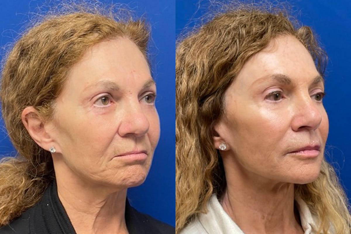 Facelift Before & After Gallery - Patient 256427 - Image 2