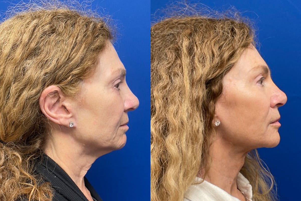 Facelift Before & After Gallery - Patient 256427 - Image 3