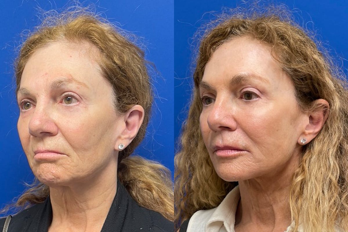 Facelift Before & After Gallery - Patient 256427 - Image 4