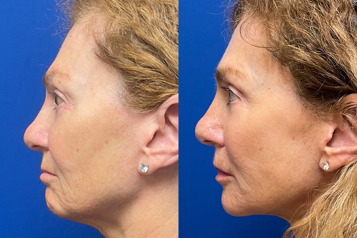 Facelift Before & After Gallery - Patient 256427 - Image 5