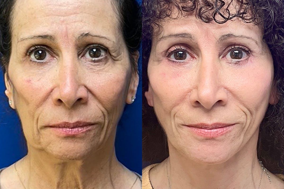 Facelift Before & After Gallery - Patient 280484 - Image 1