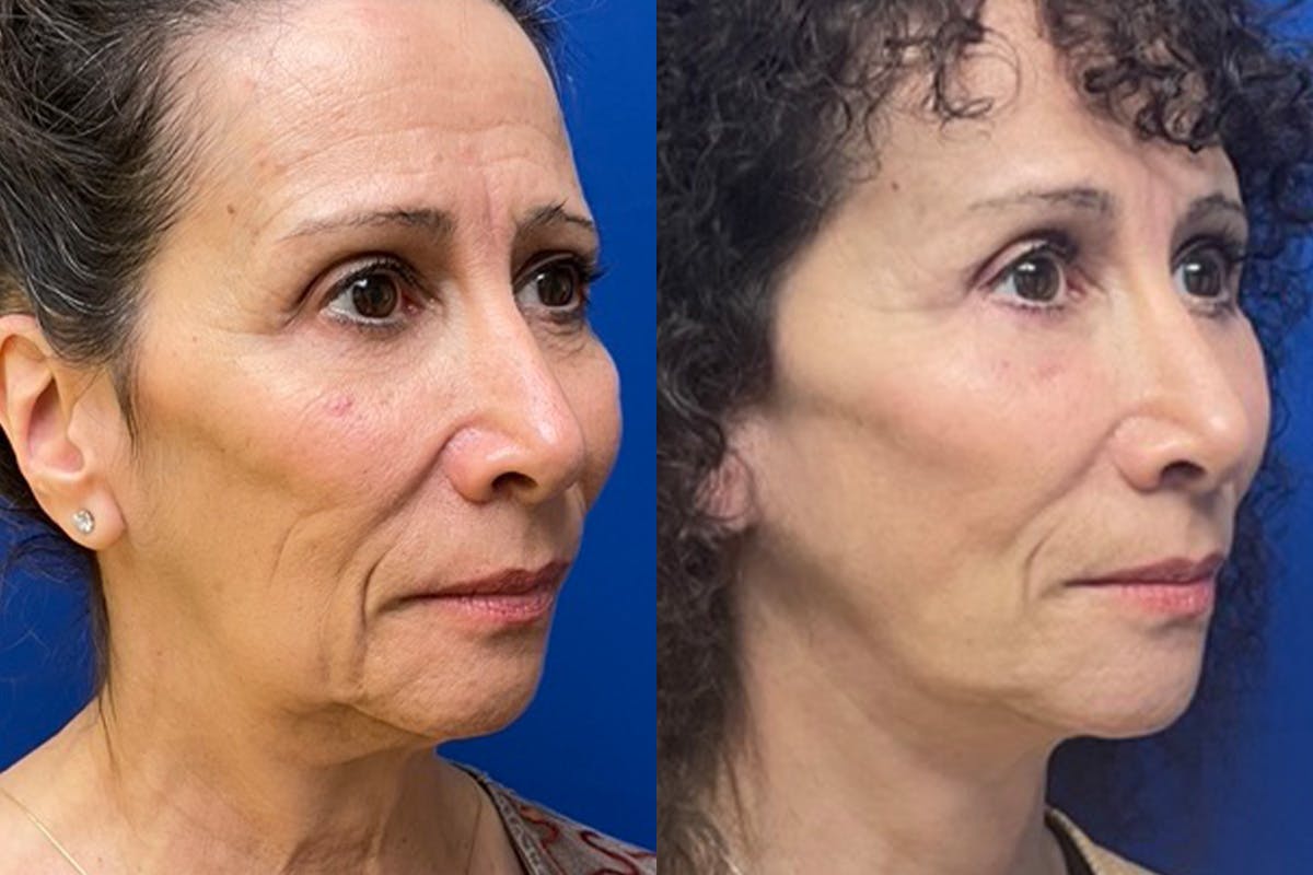 Facelift Before & After Gallery - Patient 280484 - Image 2