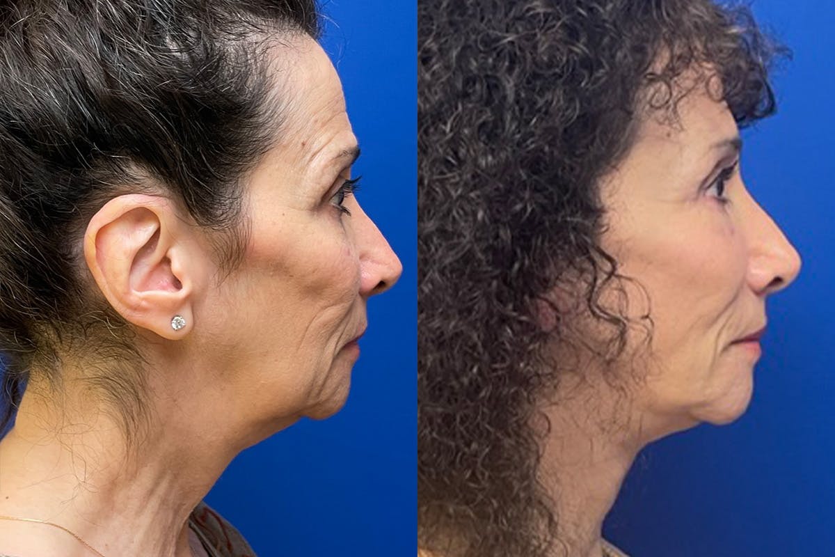 Facelift Before & After Gallery - Patient 280484 - Image 3