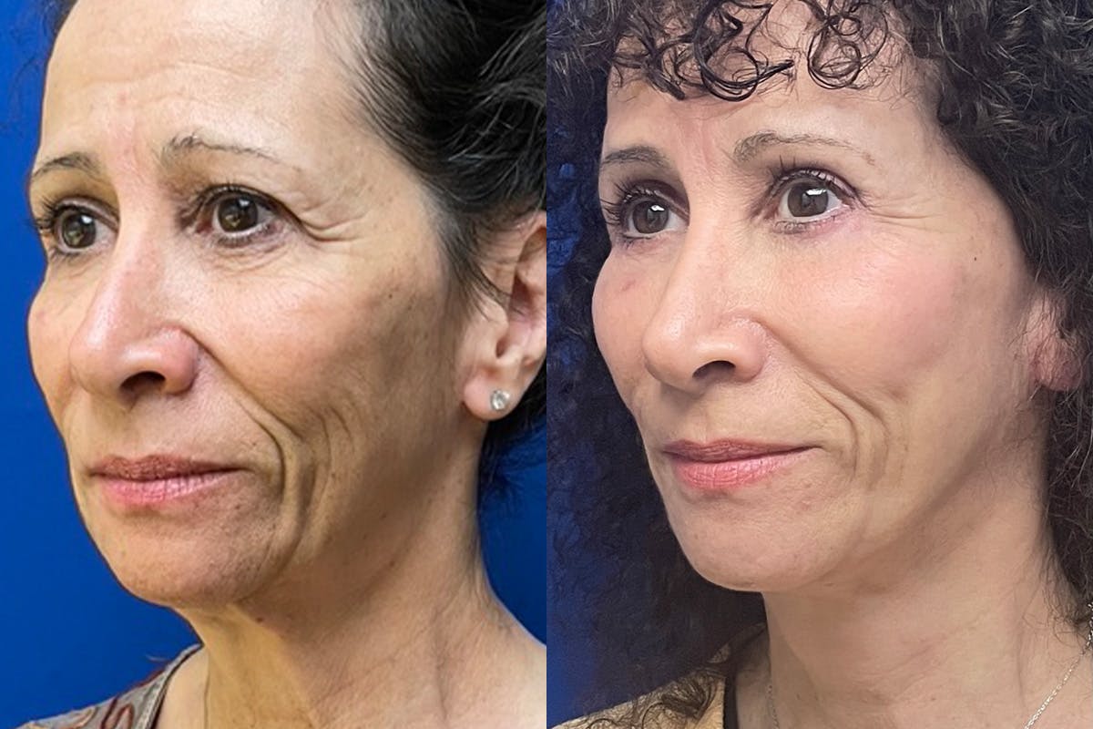 Facelift Before & After Gallery - Patient 280484 - Image 4