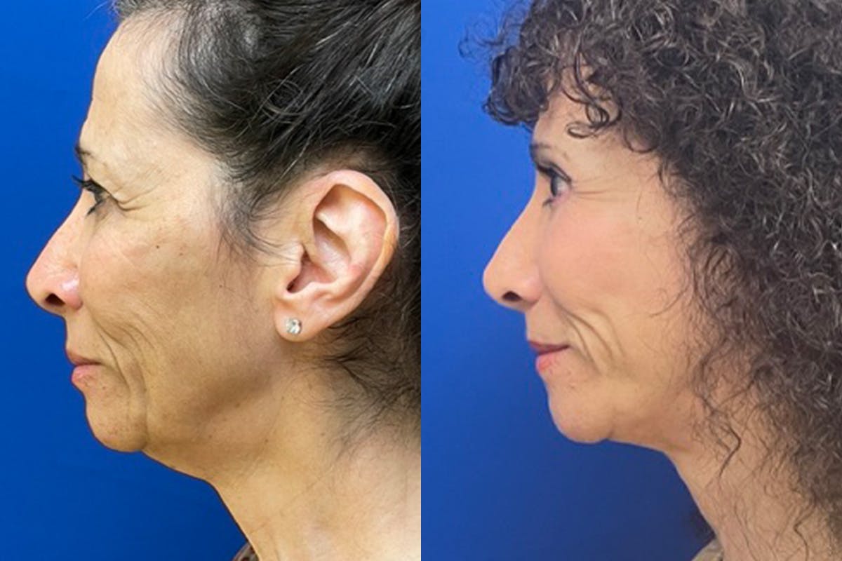 Facelift Before & After Gallery - Patient 280484 - Image 5