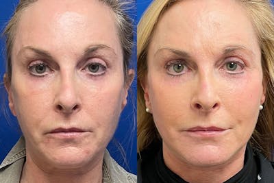 Facelift Before & After Gallery - Patient 294590 - Image 1