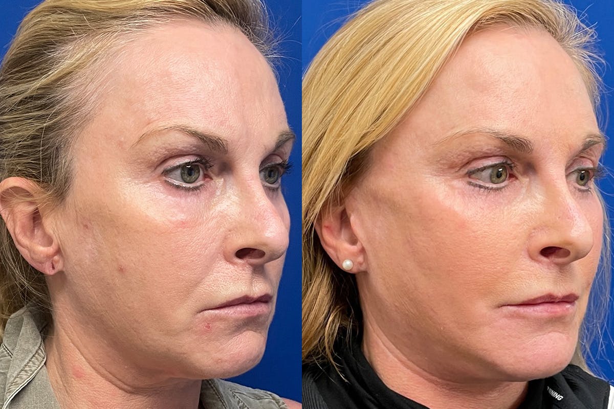 Eyelids Before & After Gallery - Patient 198035 - Image 2