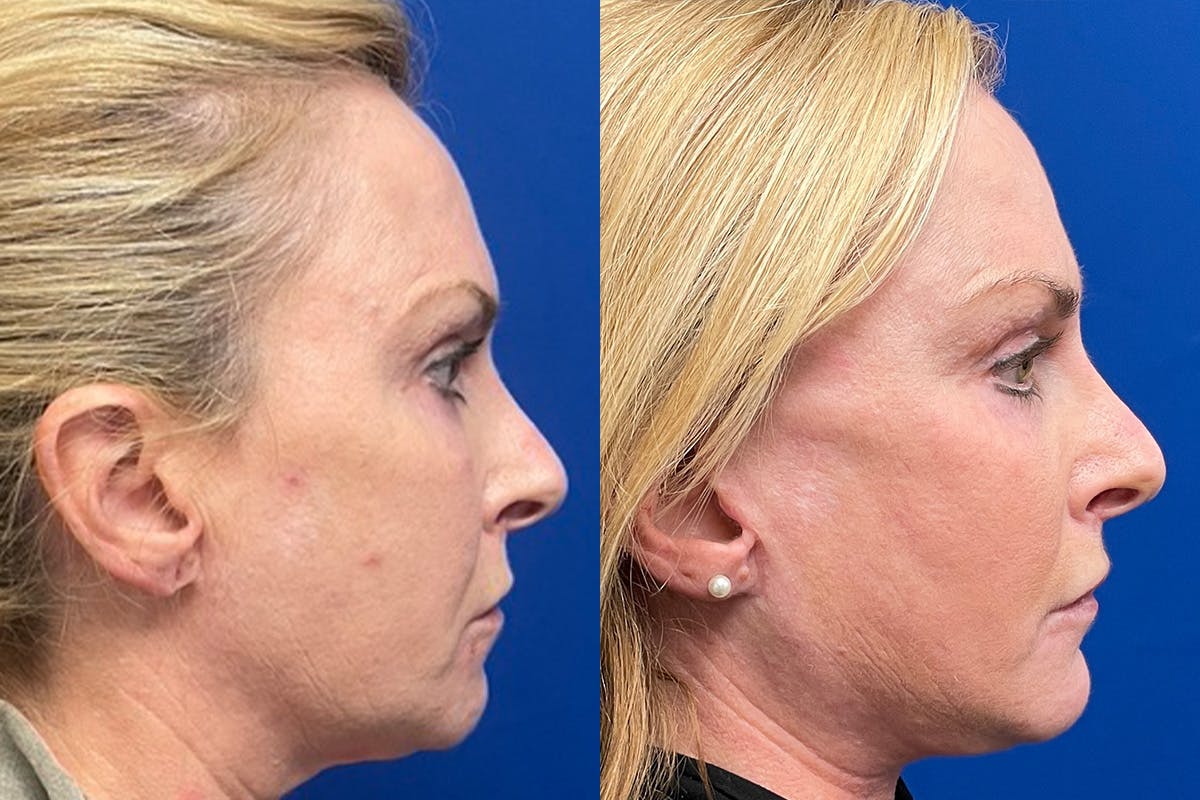 Eyelids Before & After Gallery - Patient 198035 - Image 3