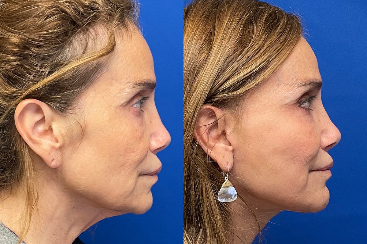 Facelift Before & After Gallery - Patient 176639 - Image 2