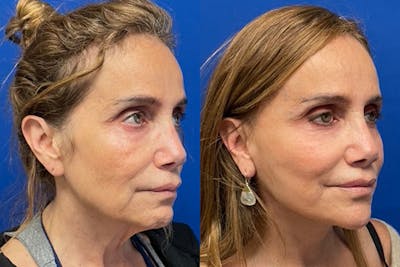 Facelift Before & After Gallery - Patient 176639 - Image 1